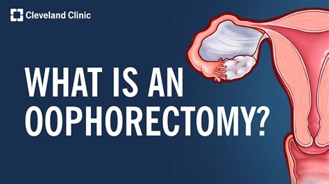 Previous research has illustrated no increased risk of complications after opportunistic <b>salpingectomy</b>. . Bilateral salpingectomy hormonal side effects